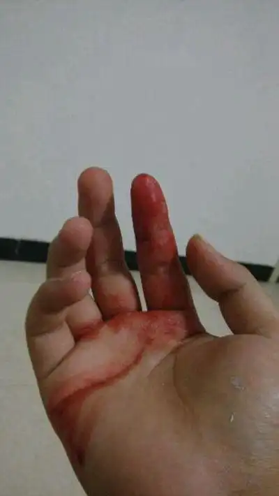 手指流血图片52
