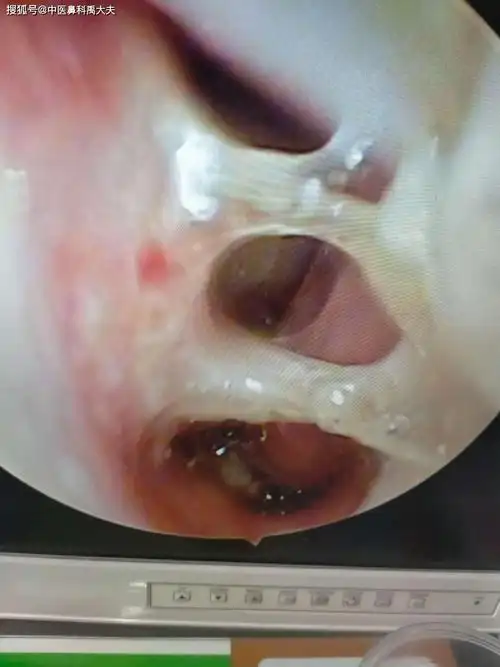 慢性鼻炎(鼻窒-脾虚湿热证)