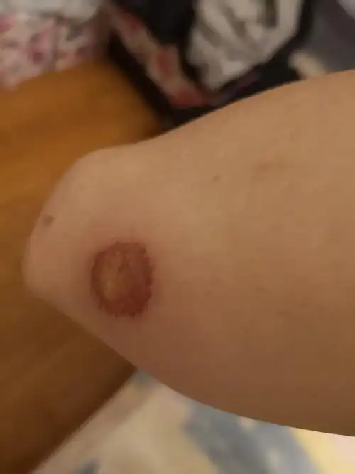 昨天考中考五十米的时候摔了一跤,刚刚洗完澡手臂灌脓出血了啊啊啊,好