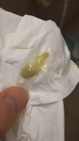 怀孕咳嗽 咳出这样的痰是严重还是慢慢好了