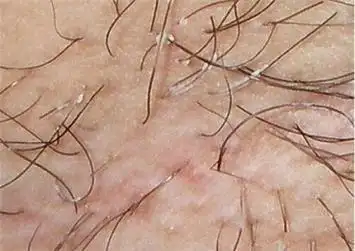 如何预防腋毛癣?不妨了解了解