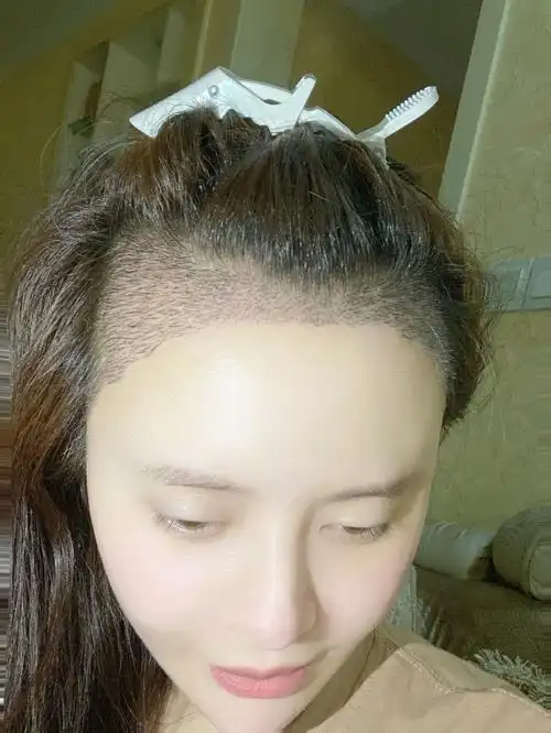 m型发际线植发第十天