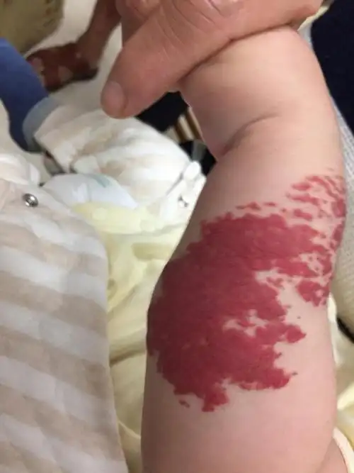 婴幼儿血管瘤宝典分享