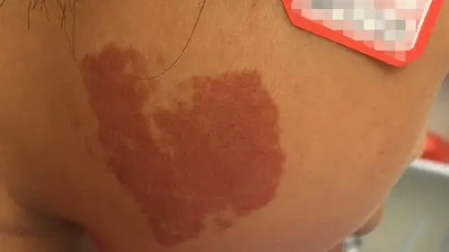 广东燕岭医院:胎记对身体有害吗?