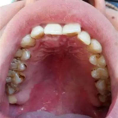 牙槽骨突出是什么原因