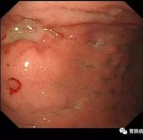 24岁女生上腹不适半年怕做胃镜医生叹息只能维持1年左右了