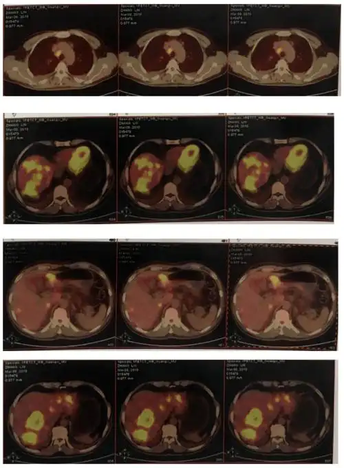 例精图治丨及时准确检测合理抗her2治疗助力胃癌晚期患者达更长os