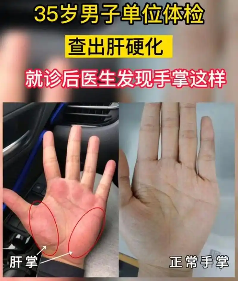 什么是肝掌?伸出你的手掌看看吧! 常见疾病 慢性乙型肝炎,肝硬化等.