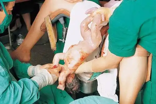 顺转剖妈妈告诉你,女人生孩子真的在搏命,关键时候为什么剖腹产胆小勿