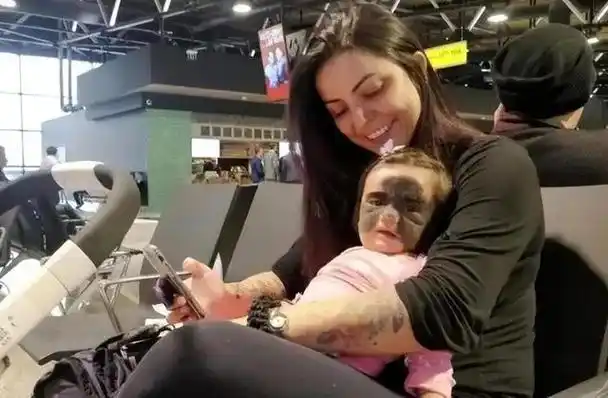 还记得天生胎记酷似"蝙蝠侠"的女婴吗?6次整容后,成功康复