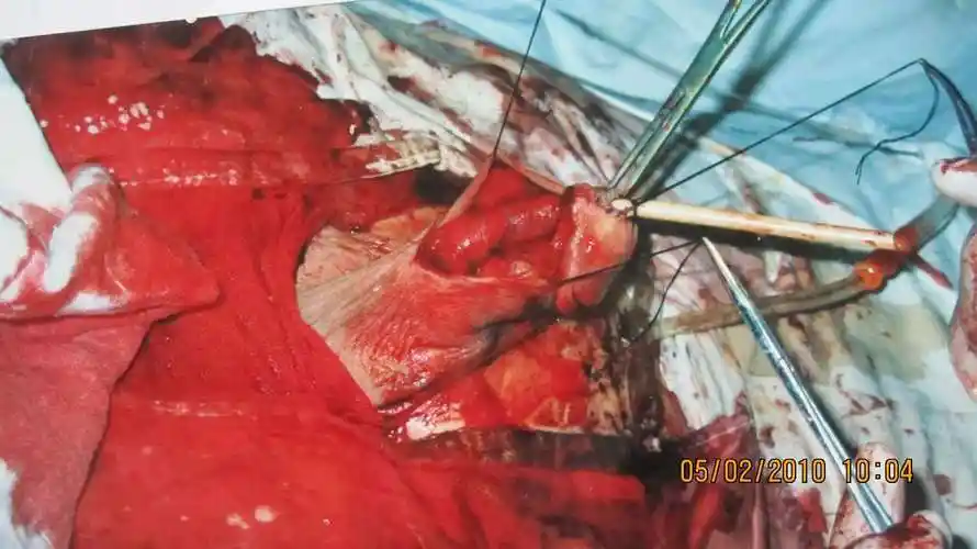 尿道下裂手术实例(二) - 好大夫在线