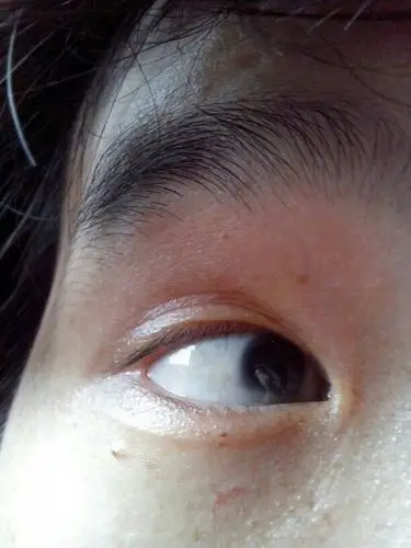 我的眼睛的眼球有点白,天生的,看东西不清楚,能治吗