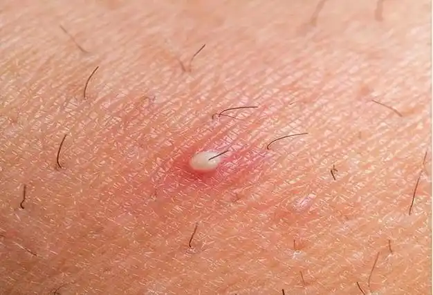 怎么在性生活前判断对象有没有性病2个方法男女都该知道