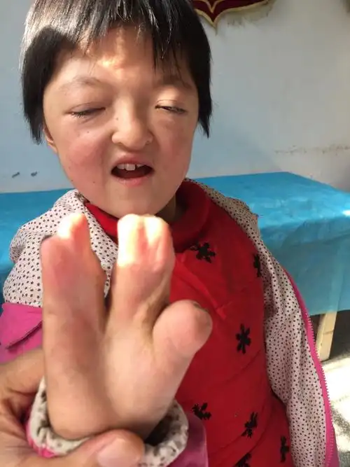 先天性并指畸形女孩