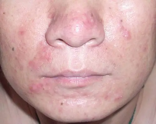 系统性红斑狼疮男性面部症状图