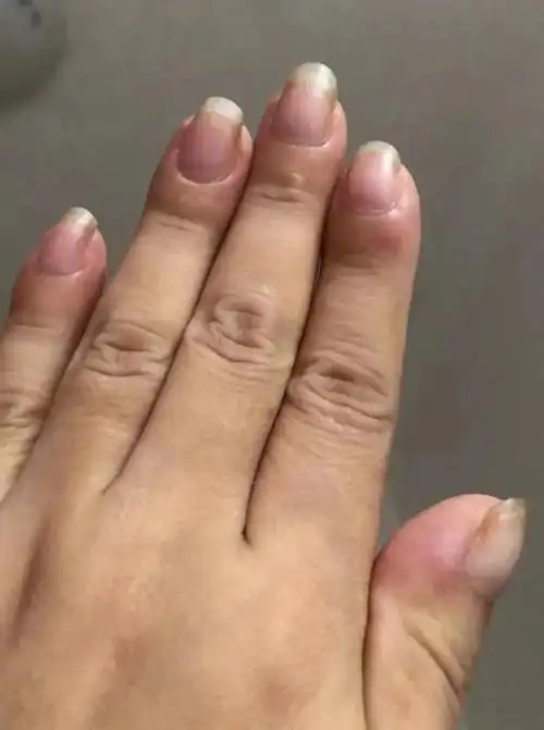 女子手指肿成萝卜头一查竟是肺癌