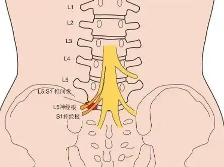 在患者存在l4～l5或l5～s1椎间盘突出因而导致l5或s1神经根受压迫时