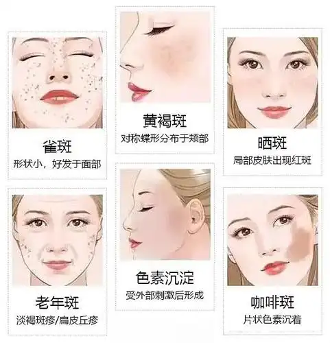 脸上长了难看的斑点,怎么办?