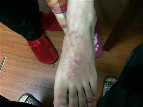 网状青斑【多图】_39医疗图集-39健康网