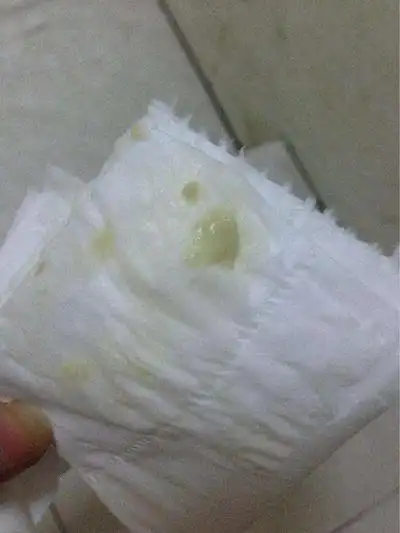 白带呈豆腐渣状图片6