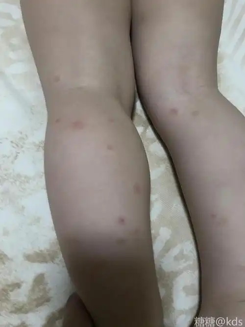 问问大家 三岁小囡腿上是发的还是虫咬的