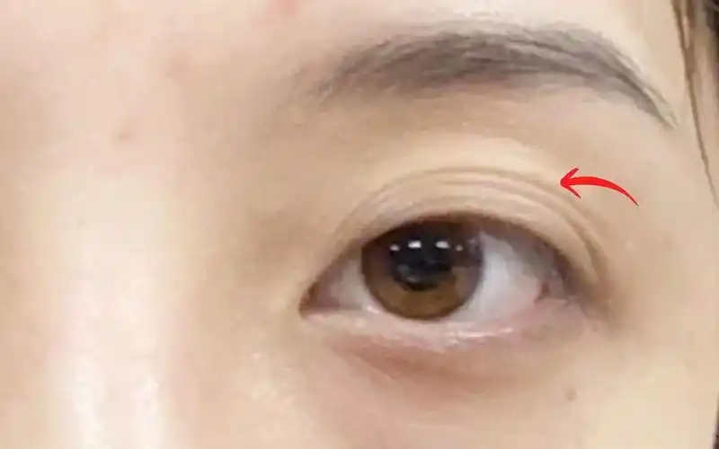 面相识人:多层眼皮