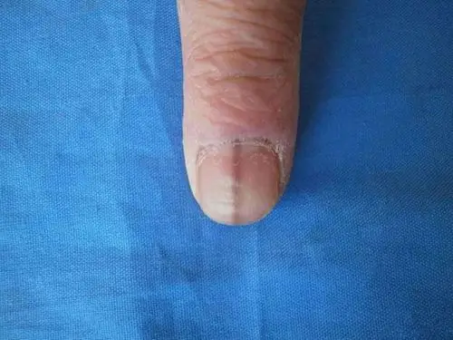 甲母痣早期图片 (32)_有来医生