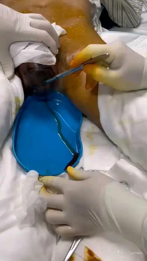 一例典型阴囊fournier坏疽 - 丁香园论坛