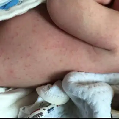 宝宝24天身上长了红点,吃奶大便都正常,也不哭闹,昨天长的,今天比昨天
