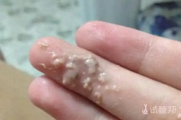 白带豆腐渣状会给人们的身体造成以下伤害