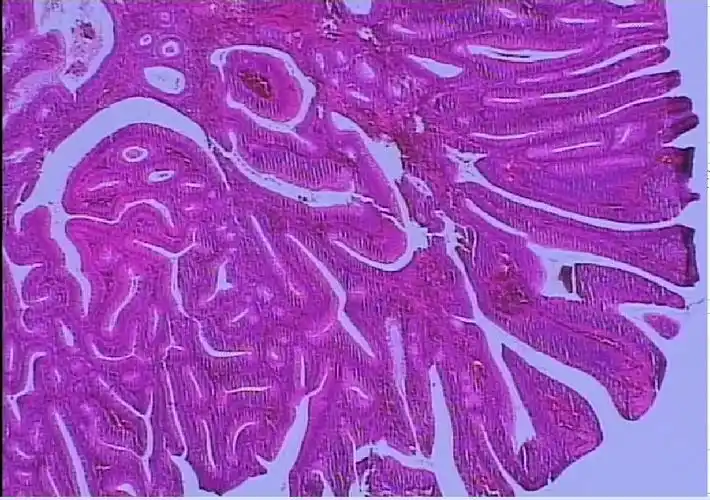 绒毛状管状腺瘤