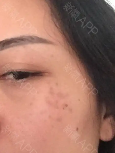 双颧骨褐青色痣十几年想做激光治疗听说要做_圈子-新氧美容整形