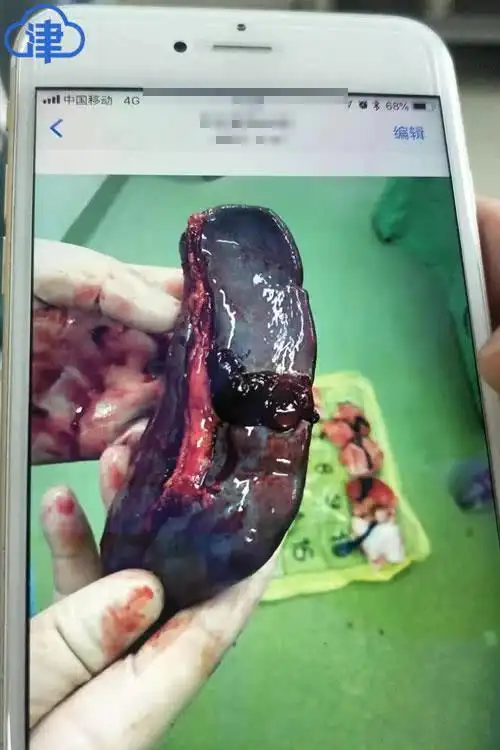 成都一精神残疾小伙遭群殴致脾脏切除究竟因逗小孩还是抢小孩