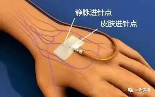 当拔针时,我们往往只会在皮肤针眼处垂直按压皮肤出血点,而忽视了静脉