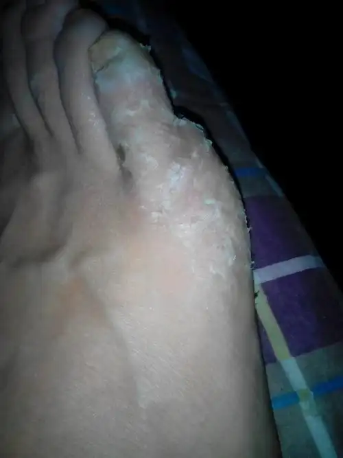 大面积脱皮趾缝痒我该怎么办