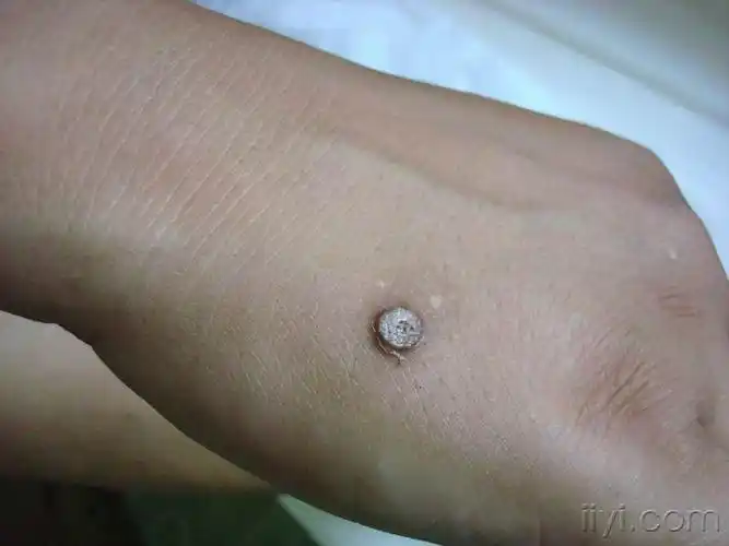 看图诊断4公布答案泛发性寻常疣