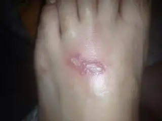 请问这个是蜘蛛疹吗?特别疼,不痒,几乎都不能走路了