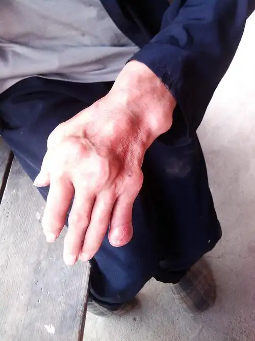 痛风症状图片手背痛风重大变形图片手脚痛风晚期的图片小腿部痛风症状