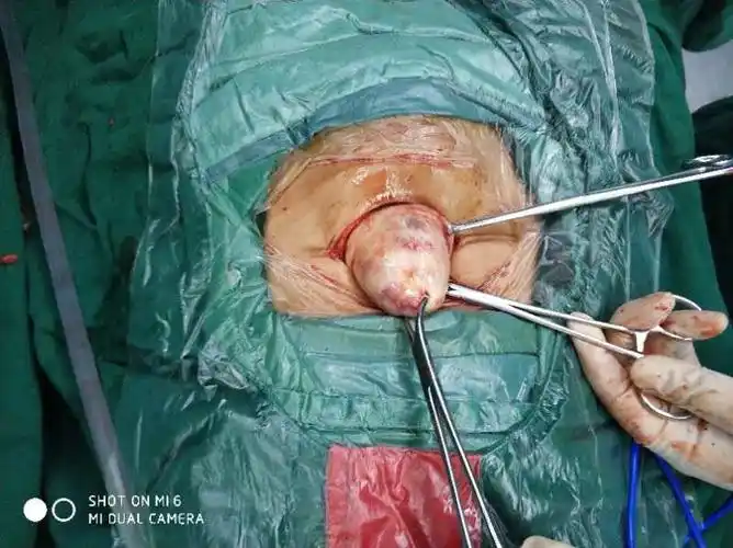 子宫肌瘤合并腹壁子宫内膜异位症开腹还是腹腔镜手术