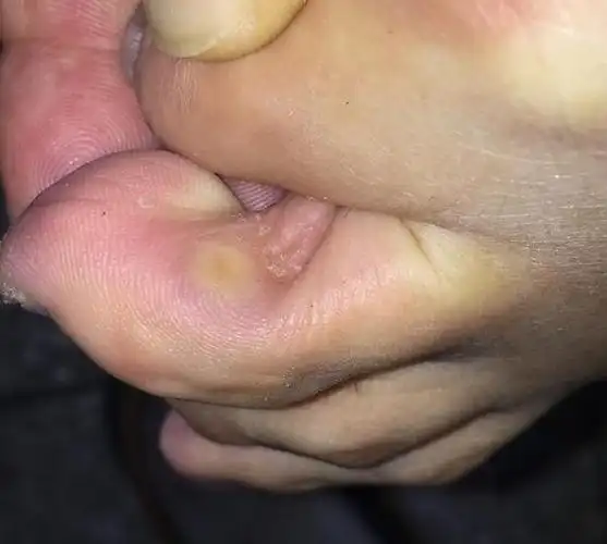 脚趾缝长了个特别痛的疙瘩,到底是瘊子还是鸡眼?