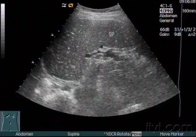 脾大脾实质弥漫分布点状强回声zengerya