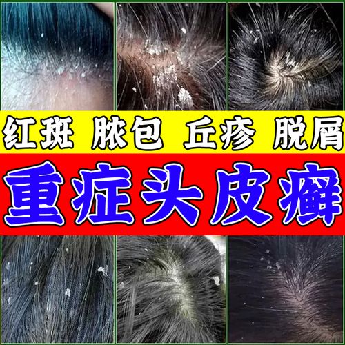 头皮癣专用保健喷剂缓解真菌感染脂溢性皮炎银屑毛炎囊干裂起皮 一