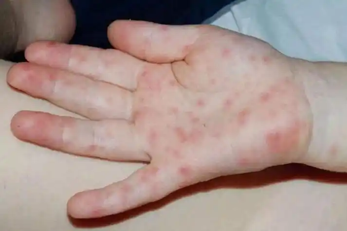 可表现为身上出现小血点,大部分病毒疹均有前驱症状,可有不同程度的