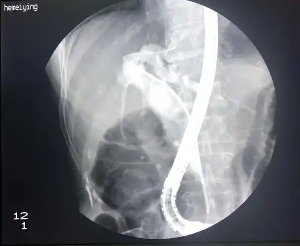 胰腺癌晚期胆管支架治标_胰腺癌 - 好大夫在线