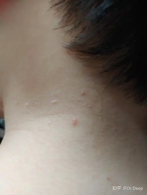 儿童传染性软疣能否自愈,会不会长到眼睛上,造成不可逆的损伤? - 知乎