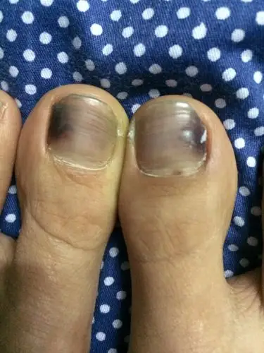 请问脚趾头指甲发黑,几个月了,不痛不痒的