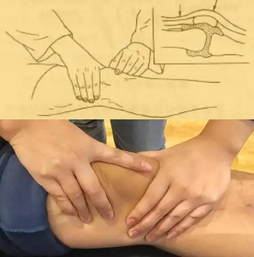 图08膝关节积液浮髌实验(关节腔积液自检)得了滑膜炎我该怎么治疗?