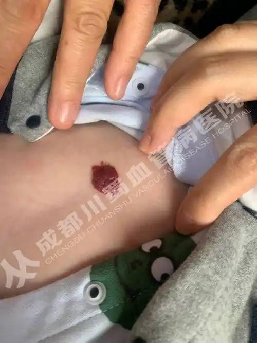 家长如何面对婴幼儿血管瘤_孩子_治疗_医生