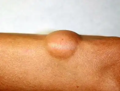 脂肪瘤向指已提到的人肘部关于指已提到的人臂照片