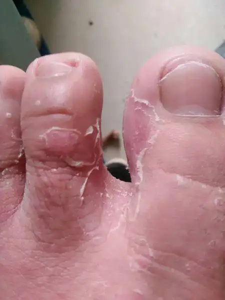 足癣脚气香港脚根治法,让你不再痒! - 好大夫在线